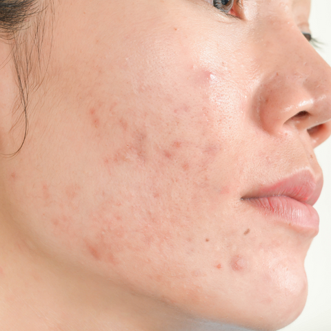 Acne Agony - Symptoms & Treatments